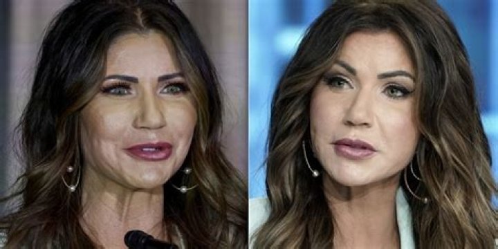 Exploring The Speculations: Did Kristi Noem Have Plastic Surgery?