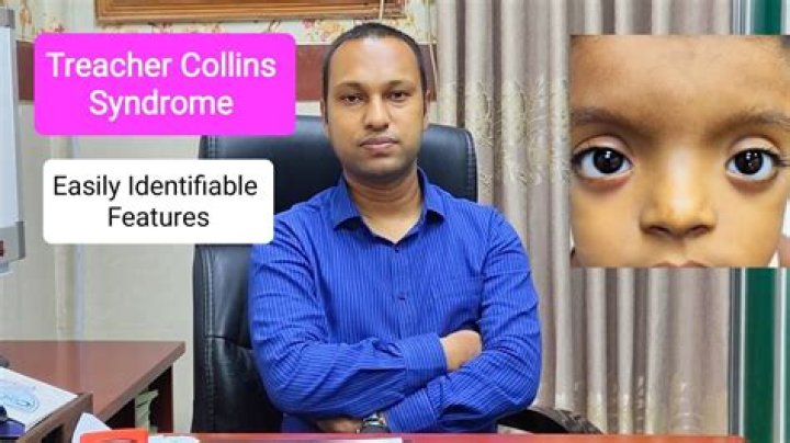 Inspiring Lives: Treacher Collins Syndrome Famous People
