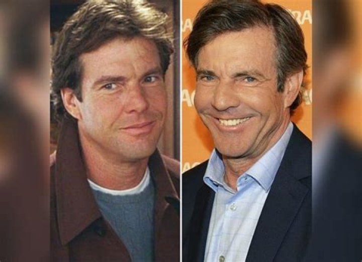 Unmasking Dennis Quaid's Plastic Surgery Journey: Before And After Revelations